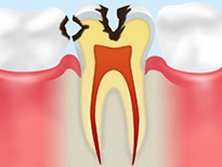 C2（象牙質の虫歯）
