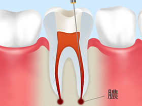 重度の虫歯には、できるだけ歯を残す「根管治療」を行います