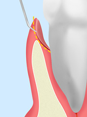 歯周ポケット掻爬（そうは）術